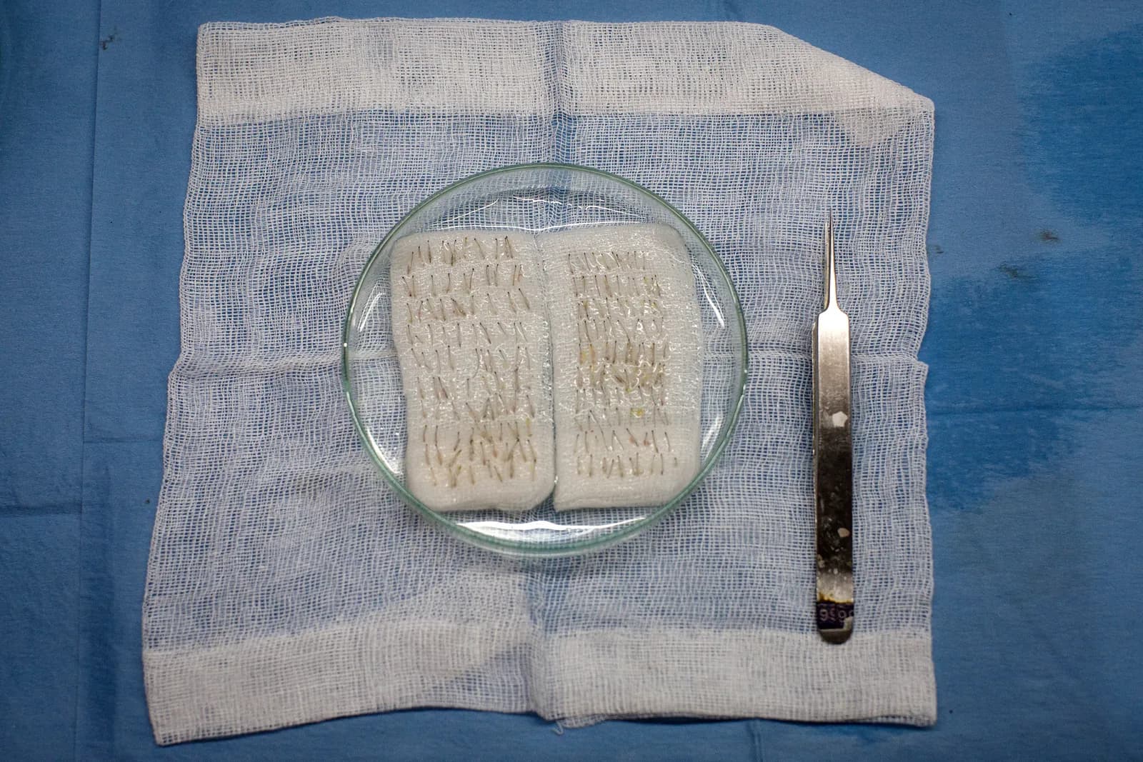 How Turkey Hacked the HairTransplant Industry