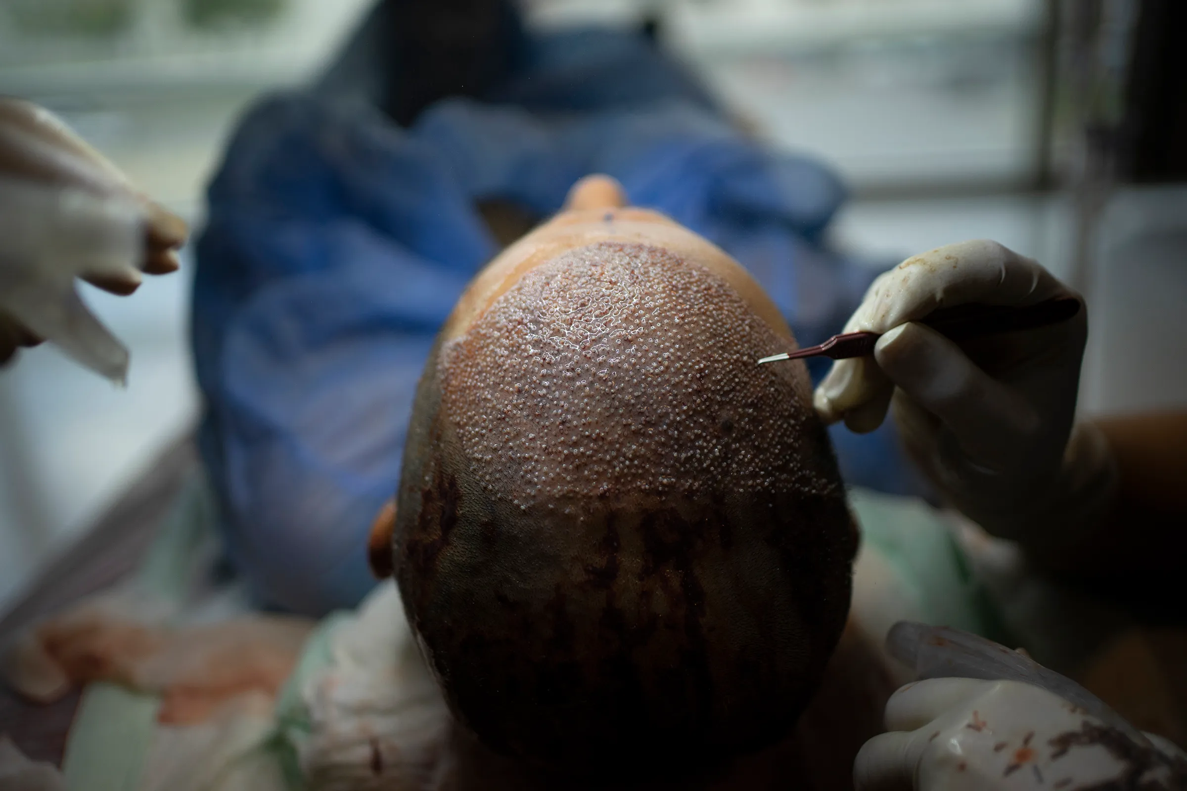 How Turkey Hacked the HairTransplant Industry
