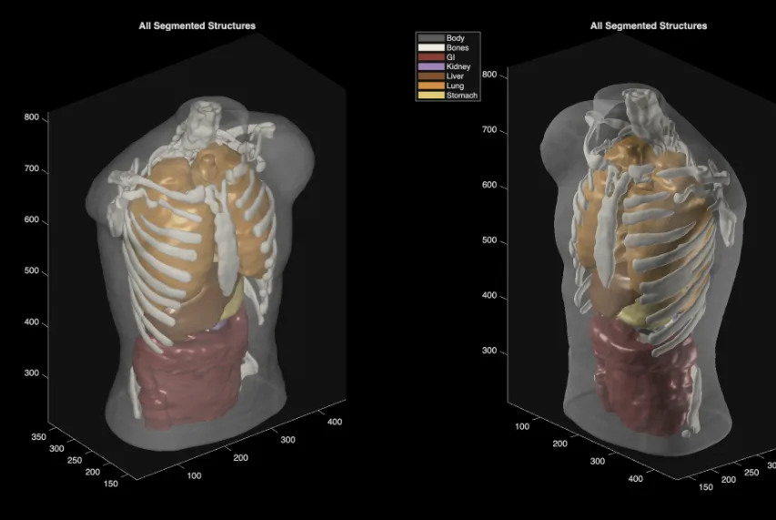 طبقة تجزئة بالذكاء الاصطناعي من Midjourney Medical فوق صورة موجات فوق صوتية بالأبيض والأسود